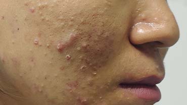 Skin Related Issue